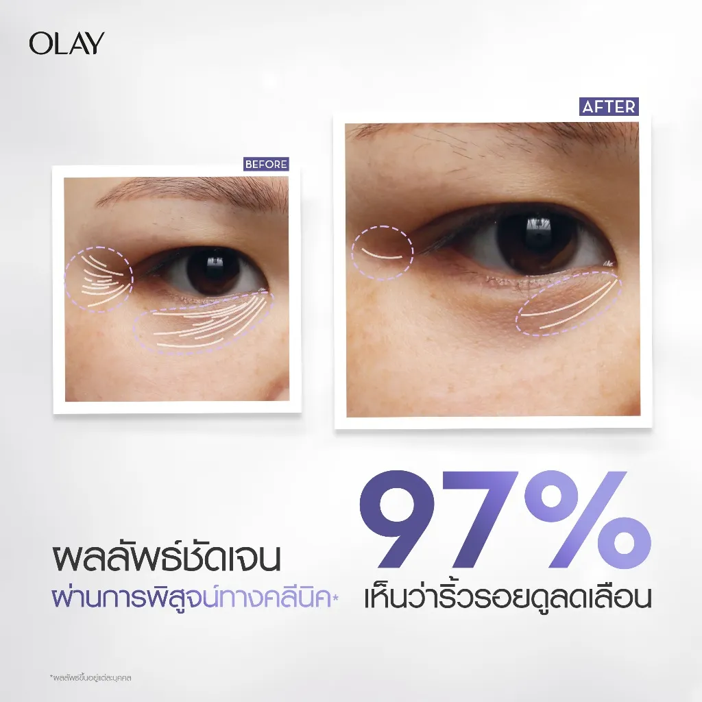 ภาพเปรียบเทียบริ้วรอยใต้ตาก่อนและหลังใช้ เห็นผลลัพธ์อย่างชัดเจน