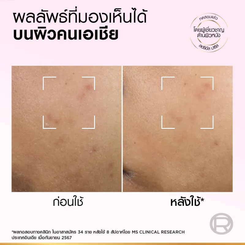 ภาพเปรียบเทียบผิวก่อนและหลังใช้ 8 สัปดาห์ แสดงรอยดำลดลงบนผิวคนเอเชีย
