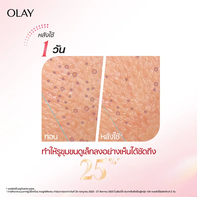 เทียบก่อนและหลัง 1 วัน แสดงจุดรูขุมขนบริเวณแก้มลดลงอย่างเห็นได้ชัด