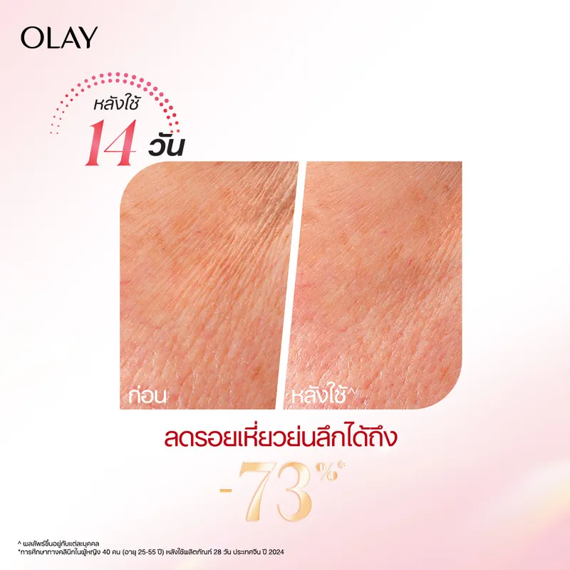 ซูมผิวแก้ม เปรียบเทียบก่อนและหลัง 14 วัน ร่องริ้วรอยตื้นลงชัดเจน