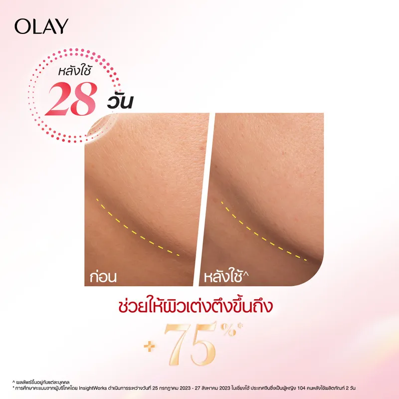 กรอบหน้าบริเวณขากรรไกร เปรียบเทียบ 28 วัน เส้นประแสดงความตึงกระชับมากขึ้น