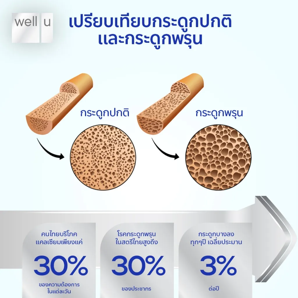 กราฟิกตัดขวางเปรียบเทียบกระดูกปกติกับกระดูกพรุน ช่องว่างมากขึ้นทางขวา
