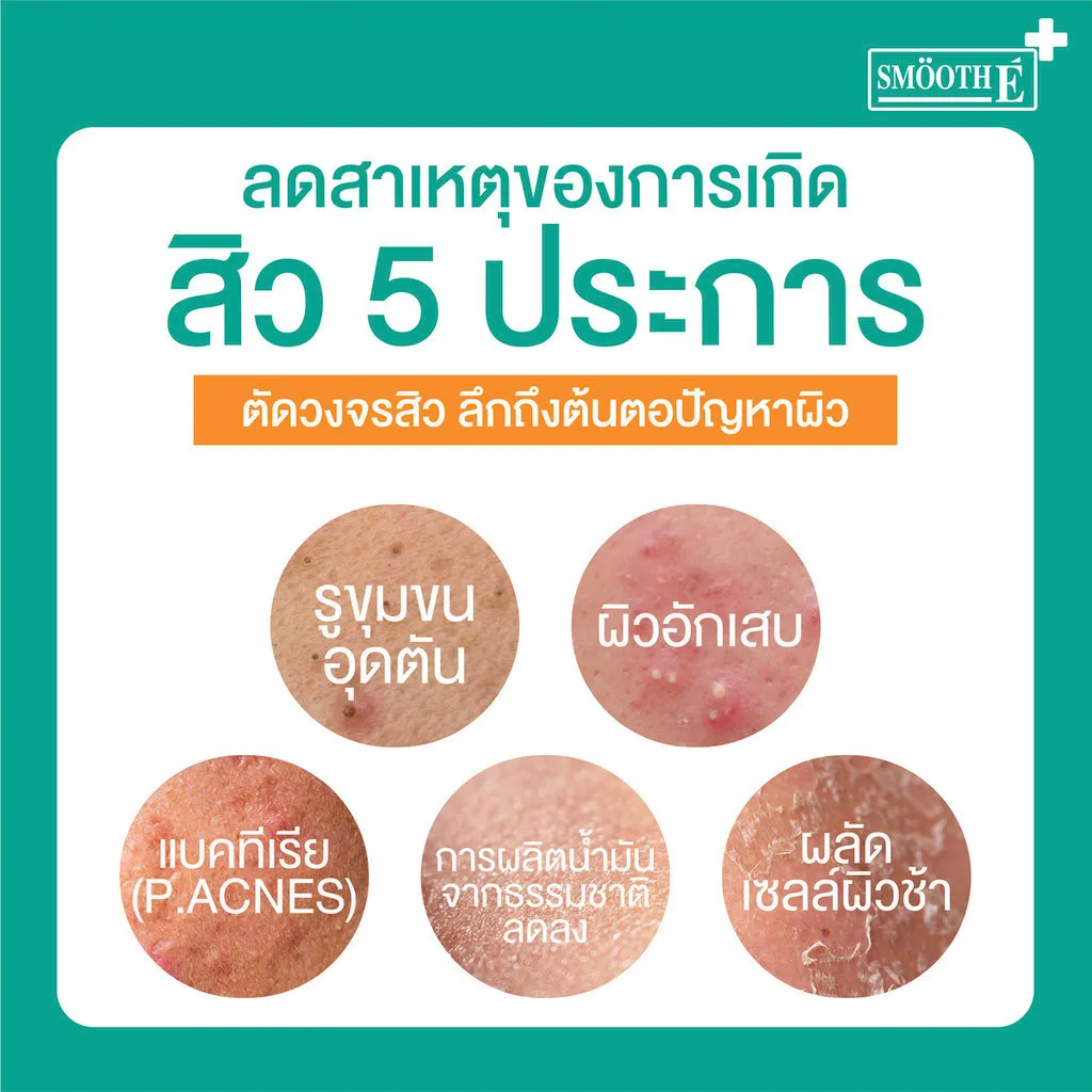 กราฟิกอธิบายปัญหาผิวห้าประเภทเช่นรูขุมขนอุดตันผิวอักเสบแบคทีเรียและการผลิตน้ำมันมากเกินไป