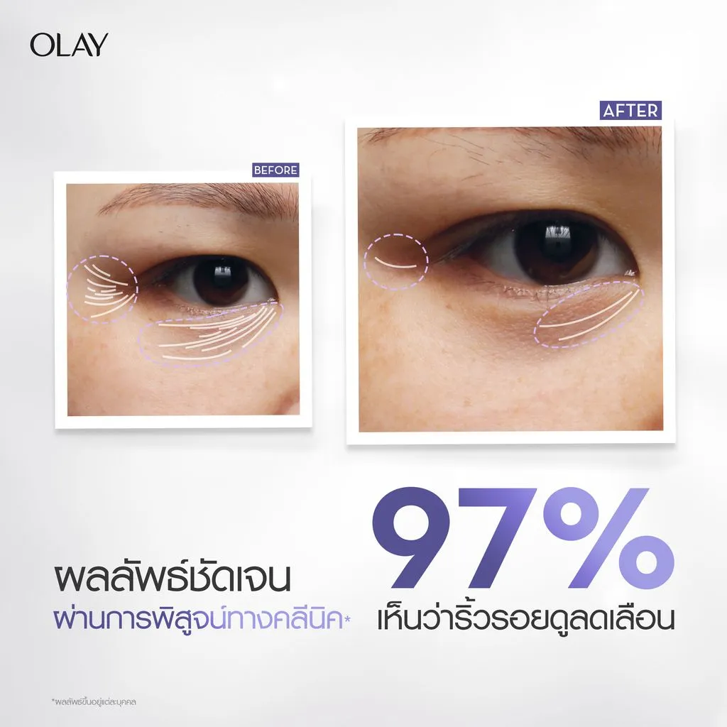 ใต้ตาก่อนและหลังการใช้ เห็นริ้วรอยและถุงใต้ตาจางลง 97% จากการทดสอบคลินิก