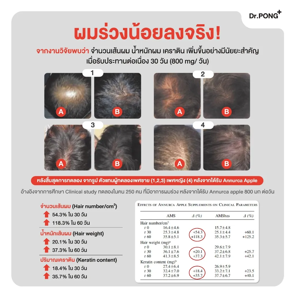 ภาพสรุปผลทดสอบก่อนและหลัง เห็นรูปหนังศีรษะหลายช่องและตารางค่าการวัดความหนาแน่น น้ำหนักเส้นผม และเคราติน