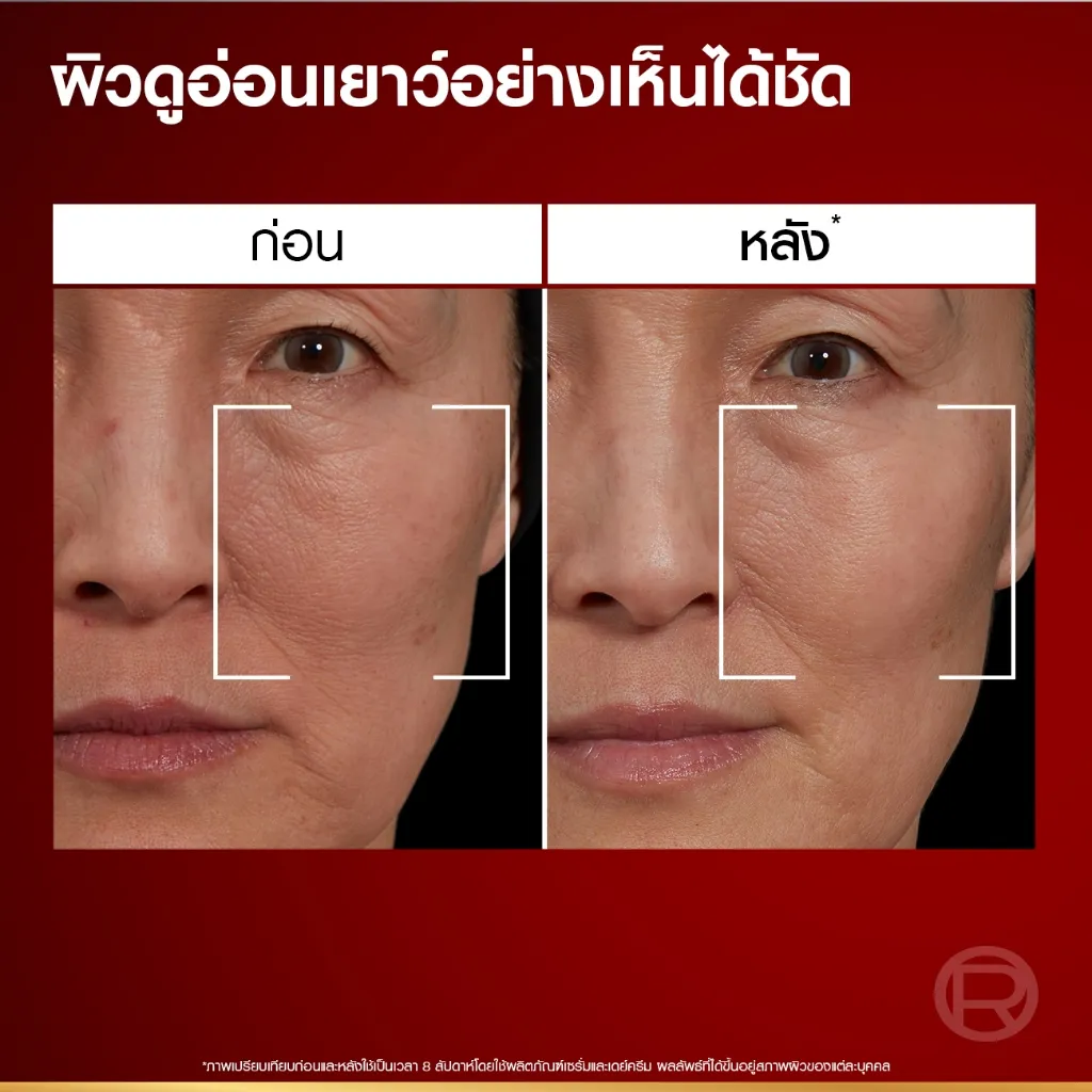ภาพเปรียบเทียบใบหน้าก่อนและหลัง เน้นบริเวณแก้มและร่องแก้มให้ดูเรียบขึ้น